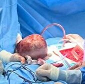 عمل جراحی موفقیت‌آمیز تومور بزرگ ۲۵ سانتیمتری در قفسه سینه بیمار در کرج