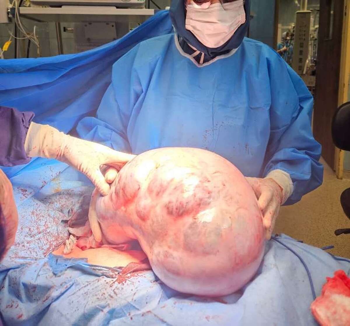 در یک عمل جراحی موفق، توده‌ای ۴۰ سانتی‌متری با وزن حدود ۱۰ کیلوگرم از شکم یک خانم ۴۲ ساله در بیمارستان کمالی کرج خارج شد.